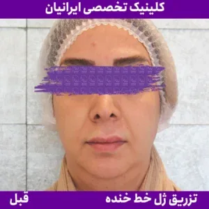 Before smile line filler, Iranian Clinic comparison 6