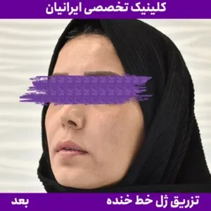 After smile line filler, Iranian Clinic comparison 7