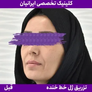 Before smile line filler, Iranian Clinic comparison 7