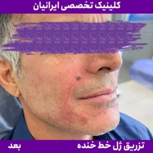 After smile line filler, Iranian Clinic comparison 8