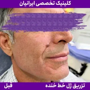 Before smile line filler, Iranian Clinic comparison 8