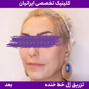 After smile line filler, Iranian Clinic comparison 9
