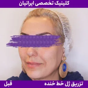 Before smile line filler, Iranian Clinic comparison 9