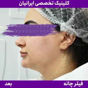 After chin filler, Iranian Clinic comparison 10