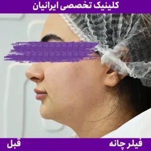 Before chin filler, Iranian Clinic comparison 10
