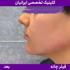 After chin filler, Iranian Clinic comparison 11
