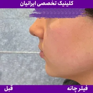 Before chin filler, Iranian Clinic comparison 11