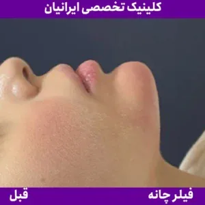 After chin filler, Iranian Clinic comparison 12