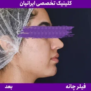 After chin filler, Iranian Clinic comparison 13