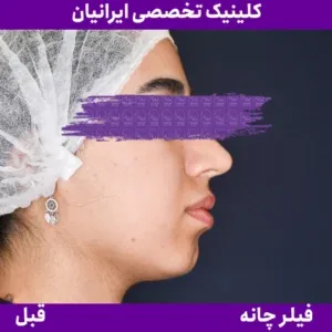 Before chin filler, Iranian Clinic comparison 13