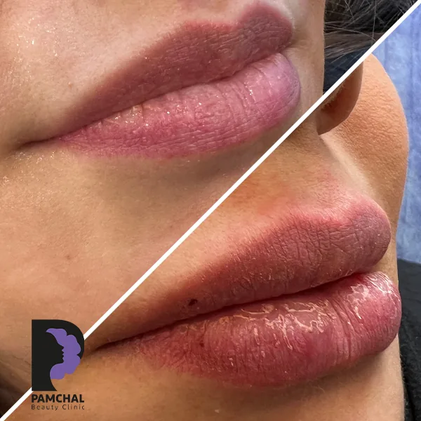 Provider-published before and after lip filler comparison 2 from Pamchal Clinic