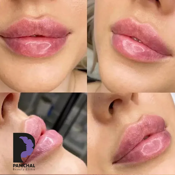 Provider-published before and after lip filler comparison 3 from Pamchal Clinic