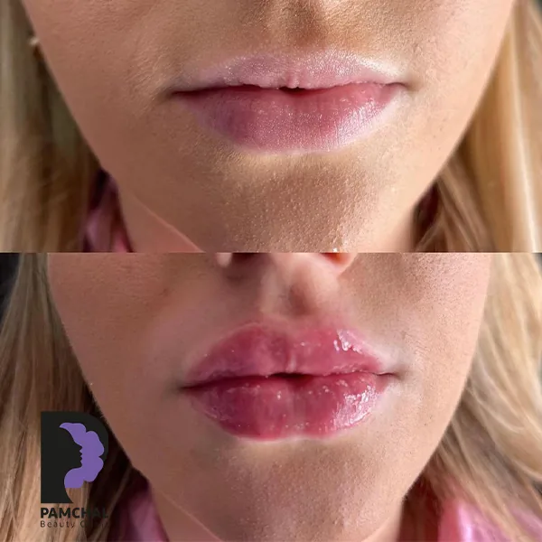 Provider-published before and after lip filler comparison 5 from Pamchal Clinic