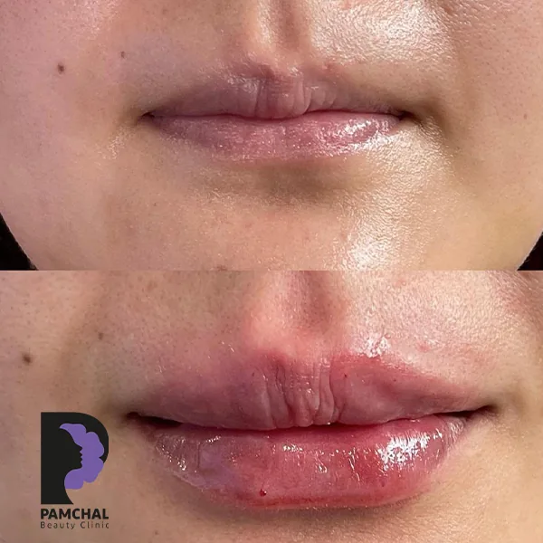 Provider-published before and after lip filler comparison 6 from Pamchal Clinic