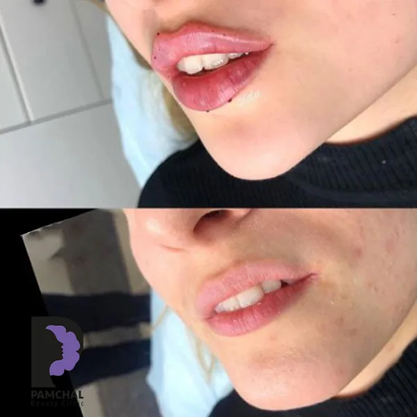Provider-published before and after lip filler comparison 7 from Pamchal Clinic