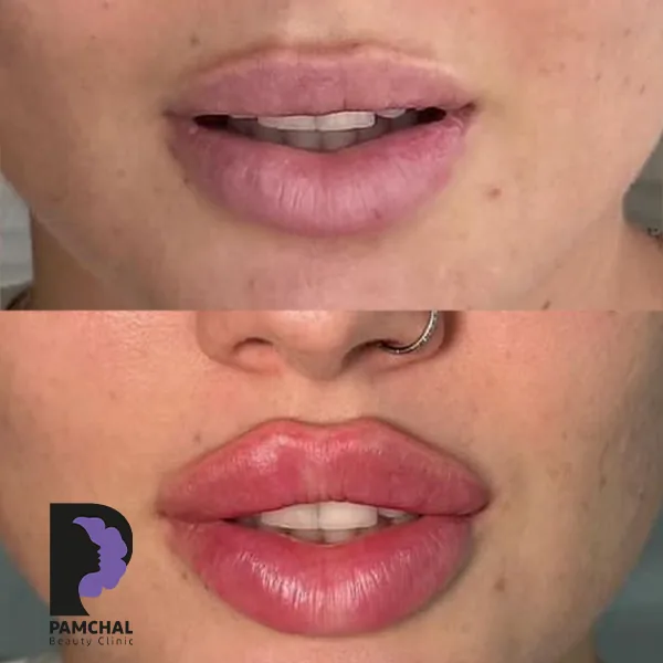 Provider-published before and after lip filler comparison 9 from Pamchal Clinic