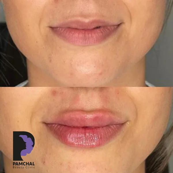 Provider-published before and after lip filler comparison 10 from Pamchal Clinic