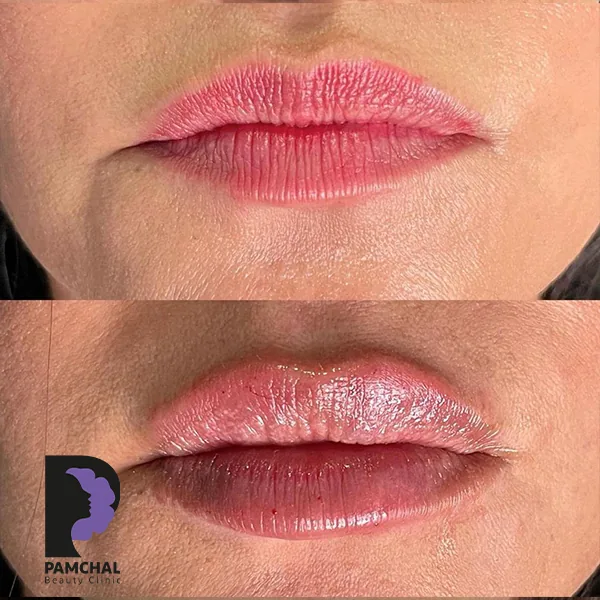 Provider-published before and after lip filler comparison 14 from Pamchal Clinic