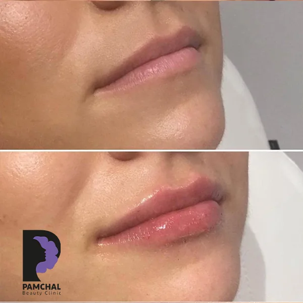 Provider-published before and after lip filler comparison 15 from Pamchal Clinic
