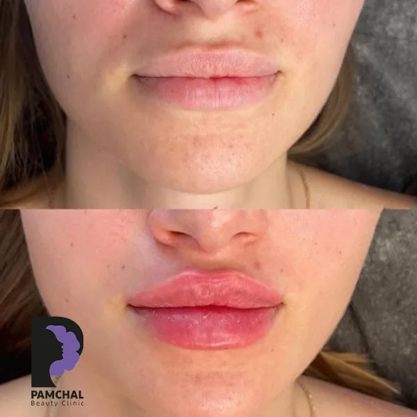 Provider-published before and after lip filler comparison 11 from Pamchal Clinic