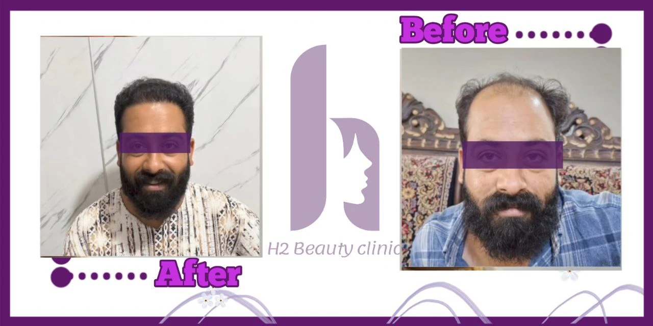 Scalp hair transplant before-and-after comparison, case 5 published by H2 Clinic