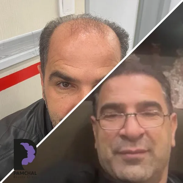 Scalp hair transplant before-and-after comparison, case 5 published by Pamchal Clinic