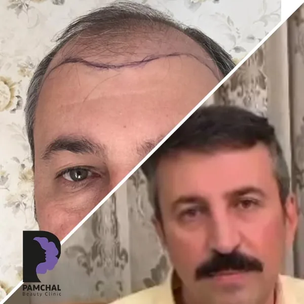 Scalp hair transplant before-and-after comparison, case 4 published by Pamchal Clinic