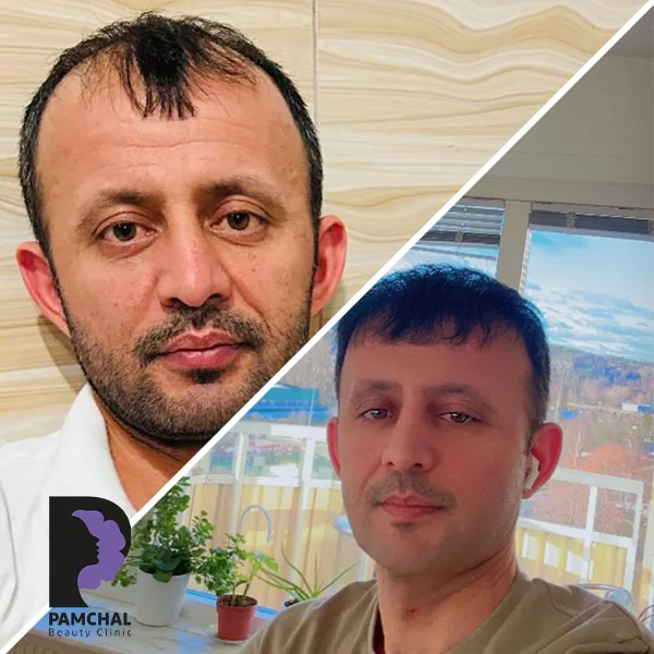 Scalp hair transplant before-and-after comparison, case 3 published by Pamchal Clinic