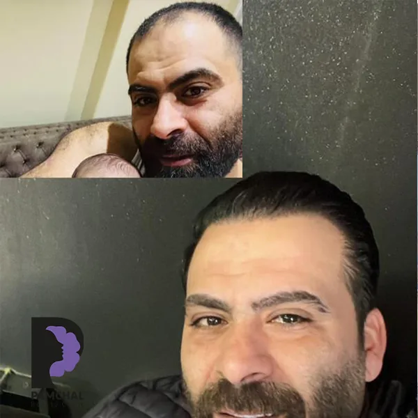 Scalp hair transplant before-and-after comparison, case 2 published by Pamchal Clinic