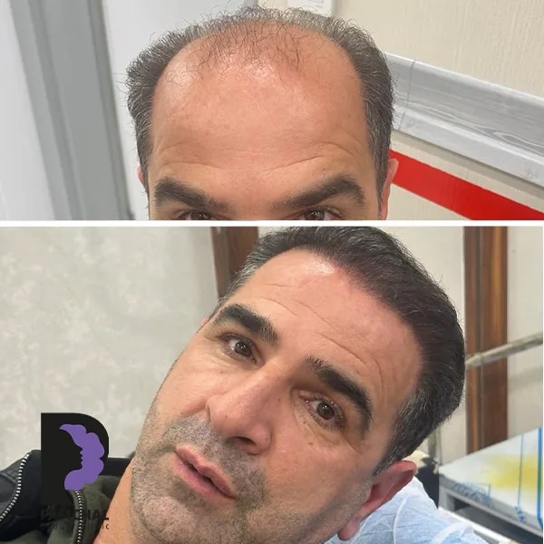 Scalp hair transplant before-and-after comparison, case 1 published by Pamchal Clinic