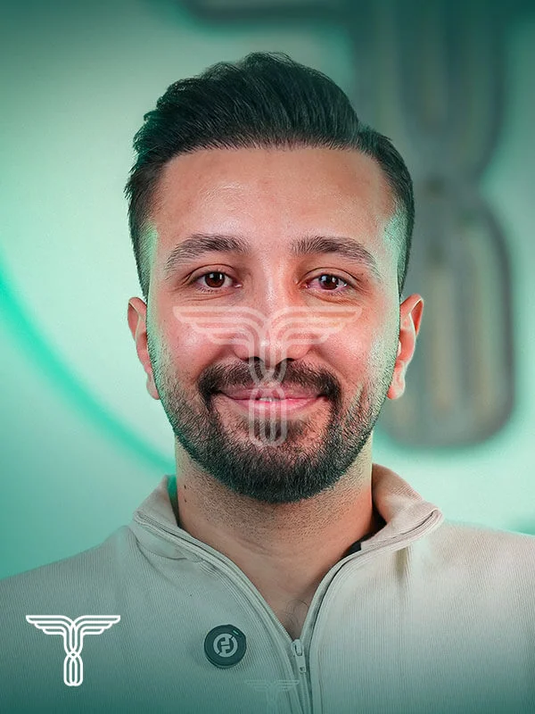 Scalp hair transplant after, case 1 published by Tehran Kasht