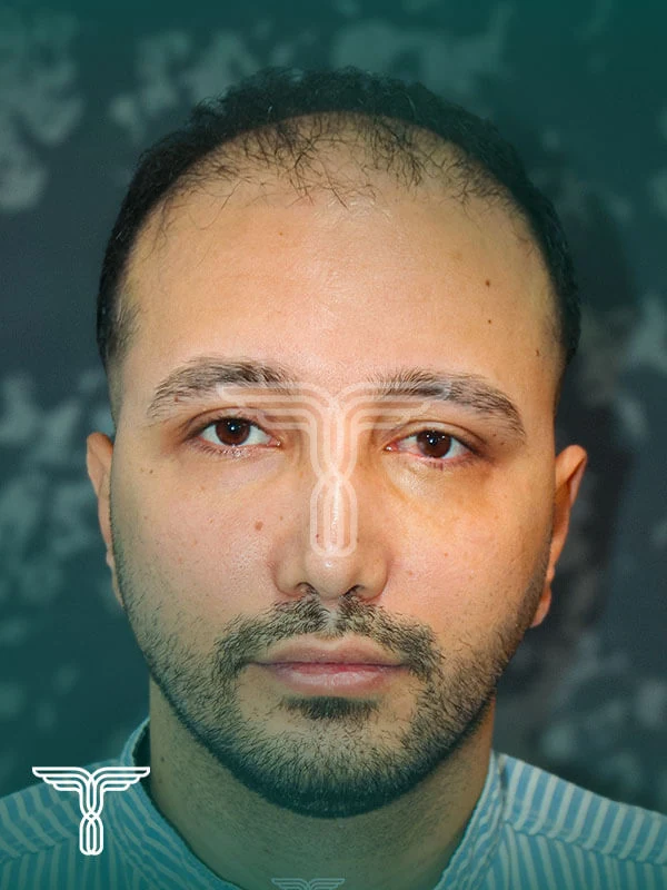 Scalp hair transplant before, case 1 published by Tehran Kasht
