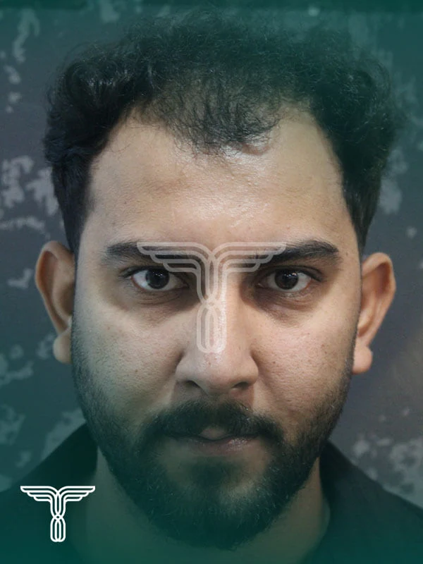 Scalp hair transplant before, case 2 published by Tehran Kasht