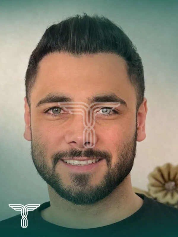 Scalp hair transplant after, case 3 published by Tehran Kasht