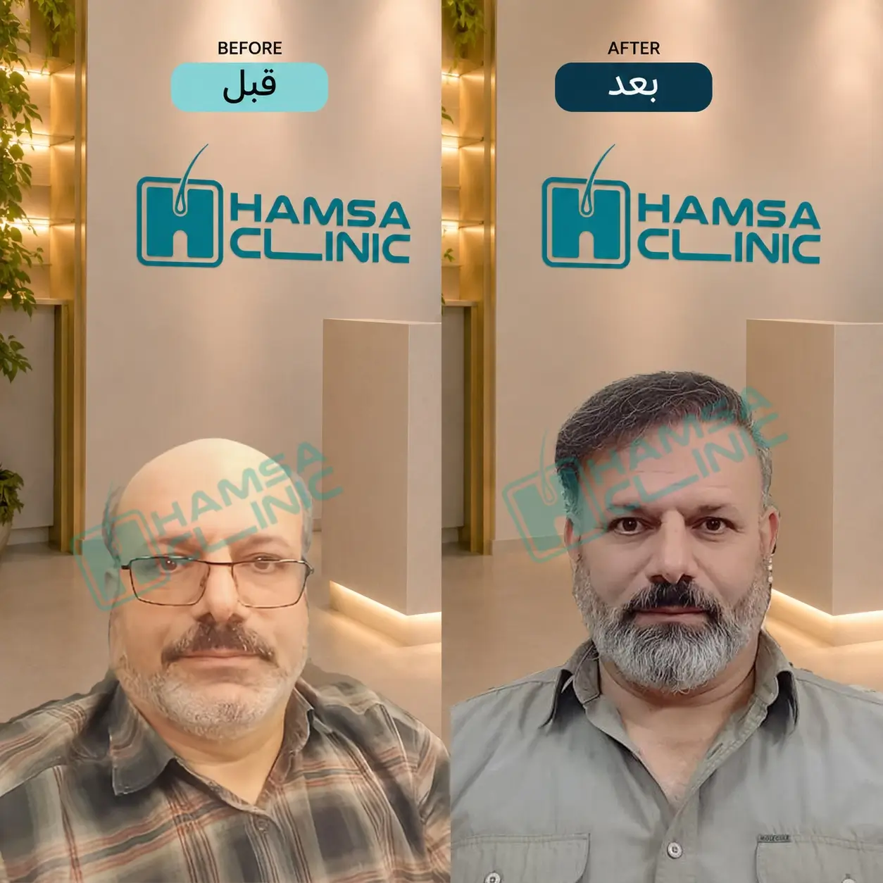 Scalp hair transplant before-and-after comparison, case 2 published by Hamsa Clinic