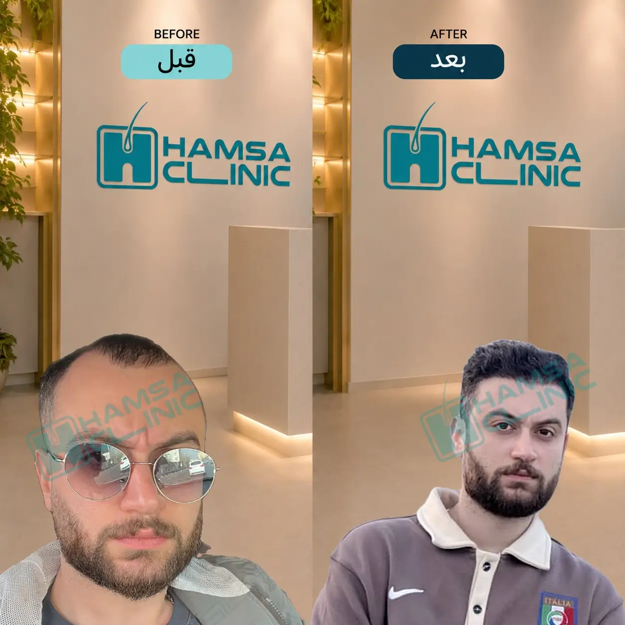 Scalp hair transplant before-and-after comparison, case 5 published by Hamsa Clinic