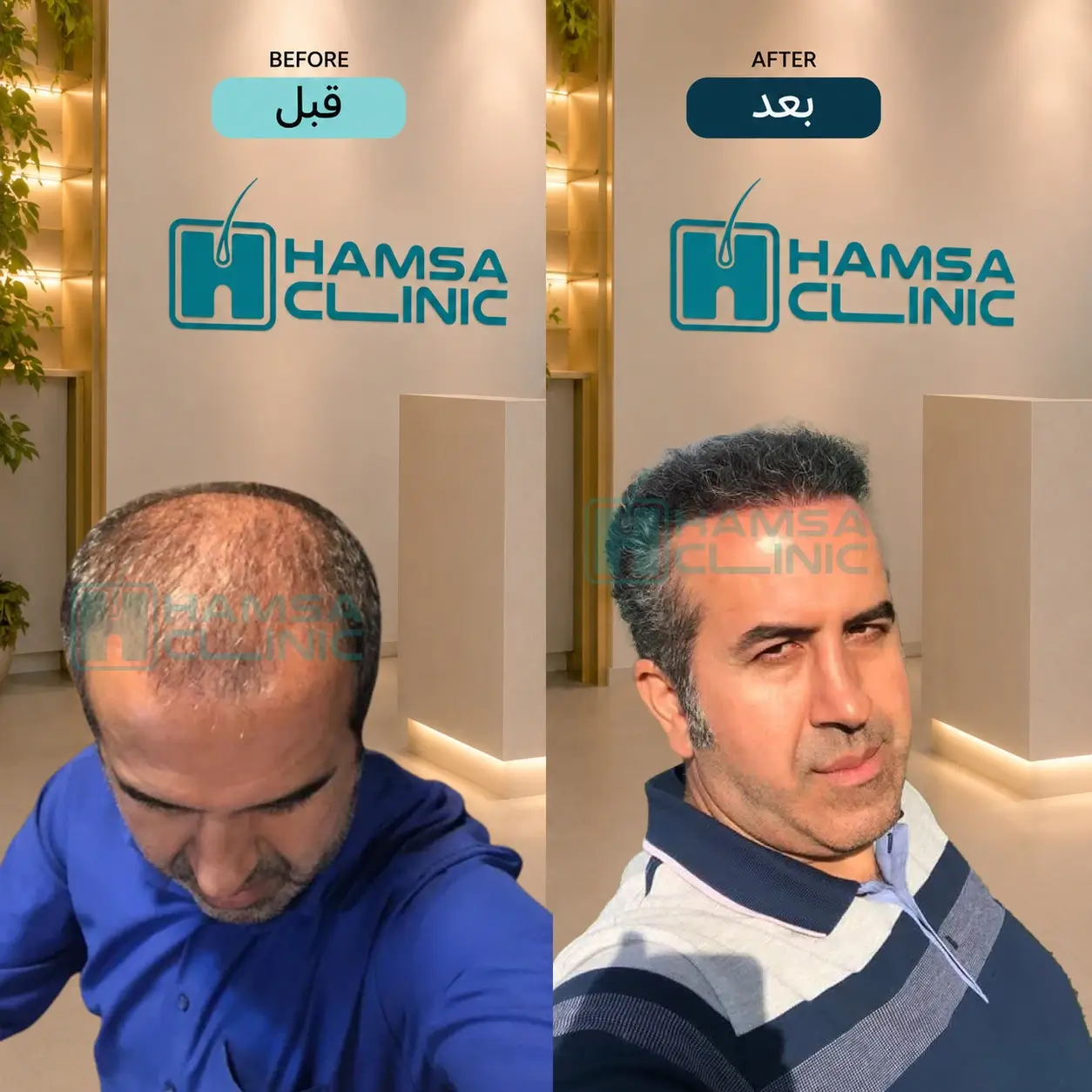 Scalp hair transplant before-and-after comparison, case 3 published by Hamsa Clinic