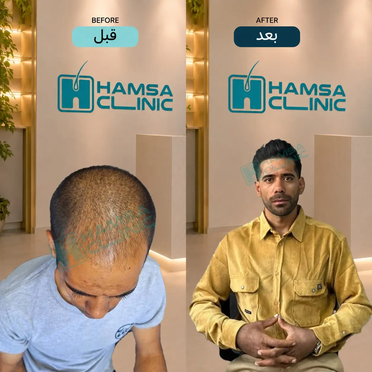 Scalp hair transplant before-and-after comparison, case 1 published by Hamsa Clinic