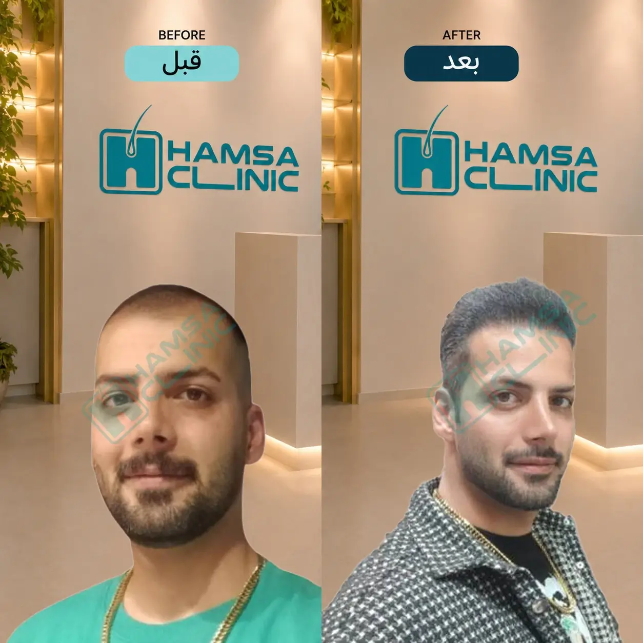 Scalp hair transplant before-and-after comparison, case 4 published by Hamsa Clinic