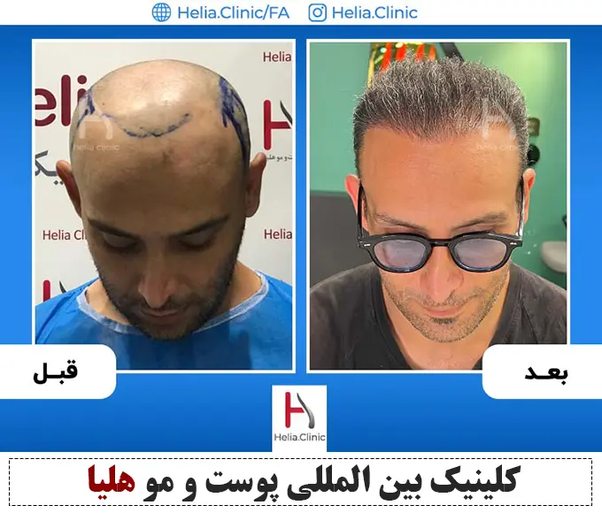 Scalp hair transplant before-and-after comparison, case 4 published by Helia Clinic — Tehran