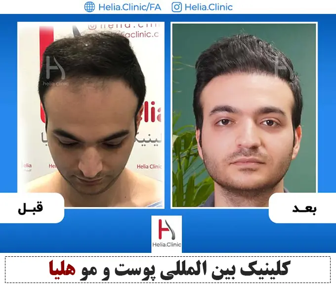 Scalp hair transplant before-and-after comparison, case 2 published by Helia Clinic — Tehran