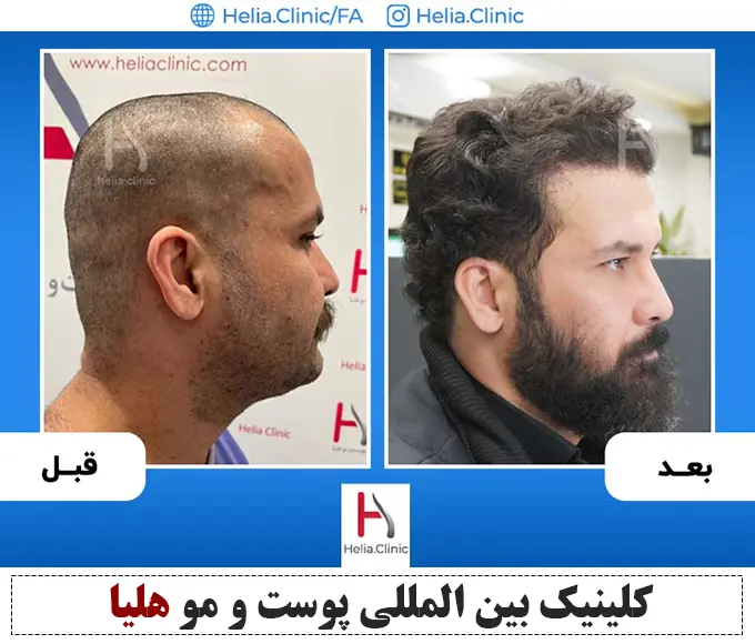 Scalp hair transplant before-and-after comparison, case 3 published by Helia Clinic — Tehran