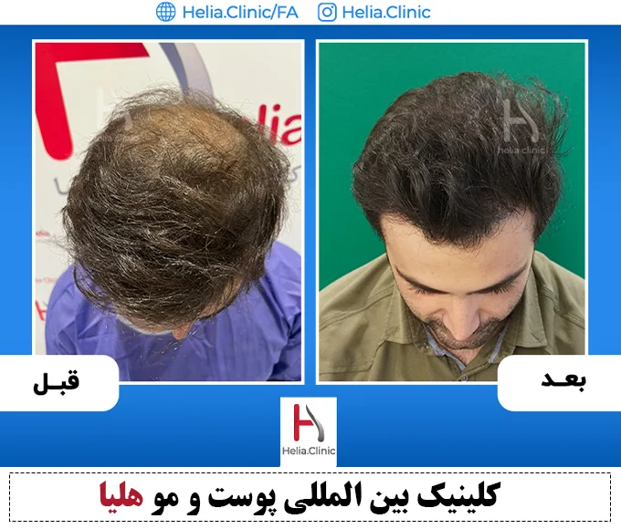 Scalp hair transplant before-and-after comparison, case 5 published by Helia Clinic — Tehran