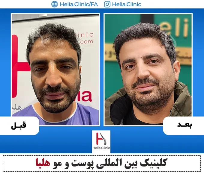 Scalp hair transplant before-and-after comparison, case 1 published by Helia Clinic — Tehran