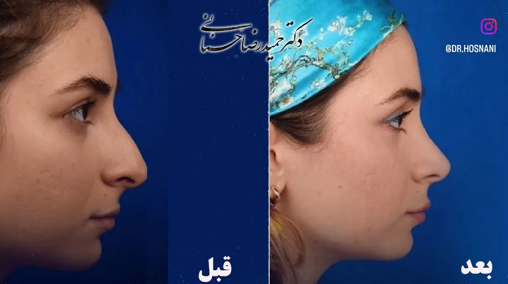 Provider-published rhinoplasty comparison image 1 from Dr. Hamidreza Hosnani