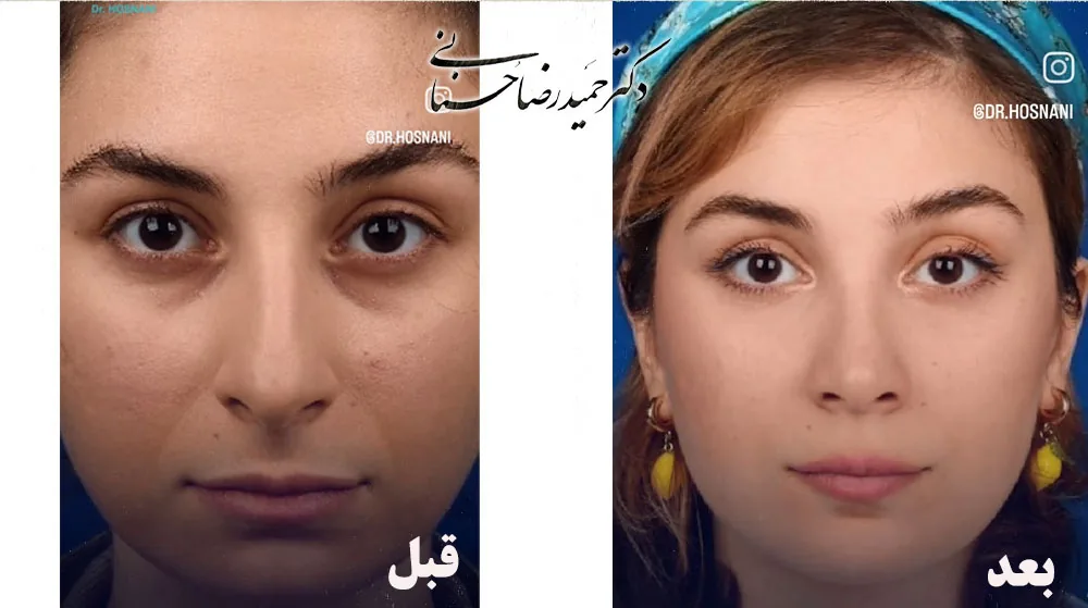 Provider-published rhinoplasty comparison image 2 from Dr. Hamidreza Hosnani