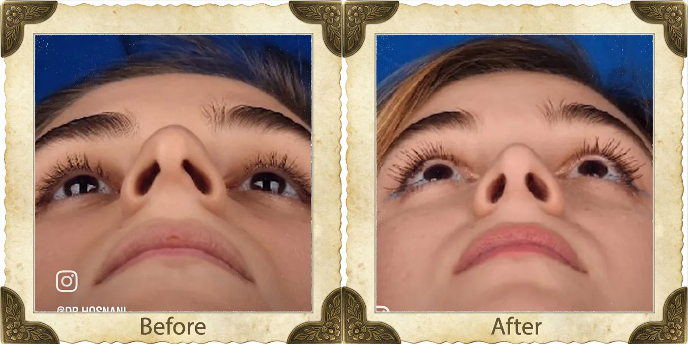 Provider-published rhinoplasty comparison image 3 from Dr. Hamidreza Hosnani