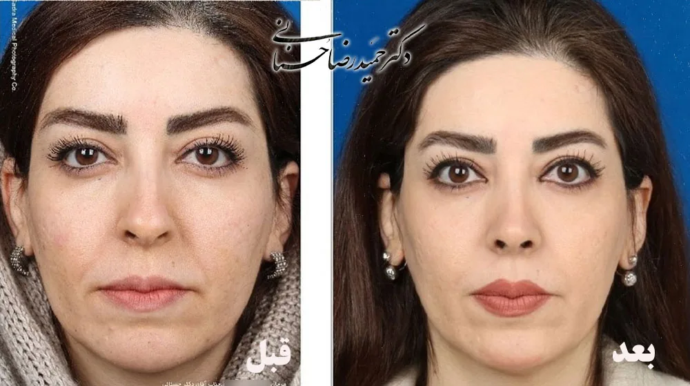 Provider-published rhinoplasty comparison image 4 from Dr. Hamidreza Hosnani