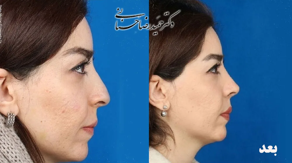 Provider-published rhinoplasty comparison image 5 from Dr. Hamidreza Hosnani