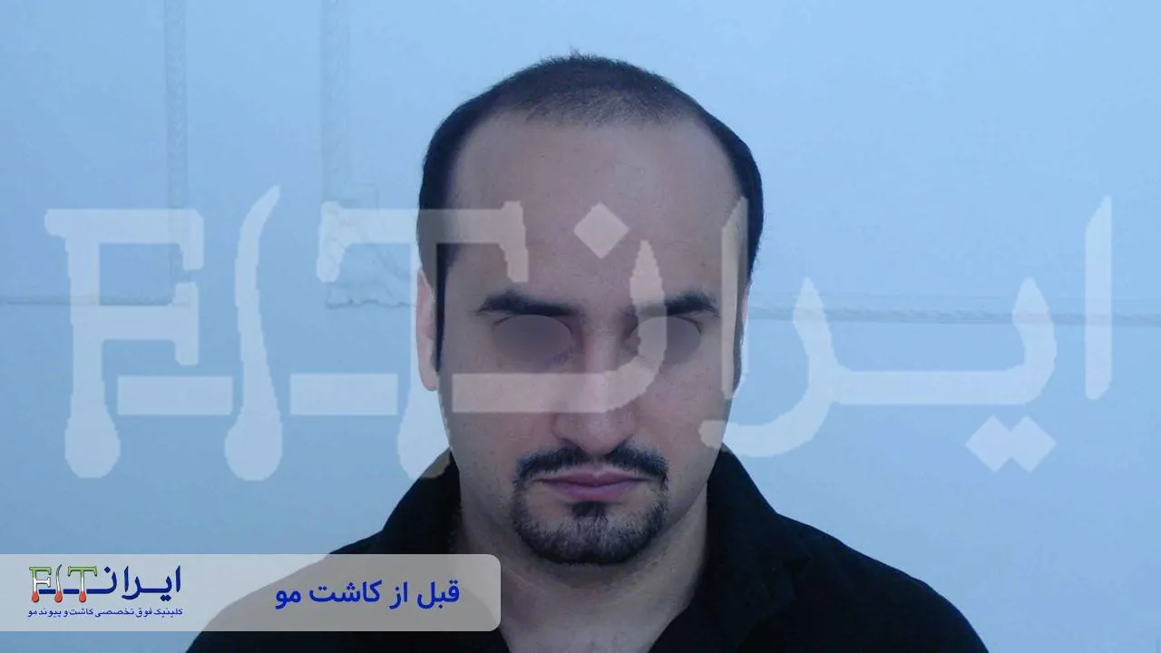 Scalp hair transplant before, case 1 published by Iran Fit Centre